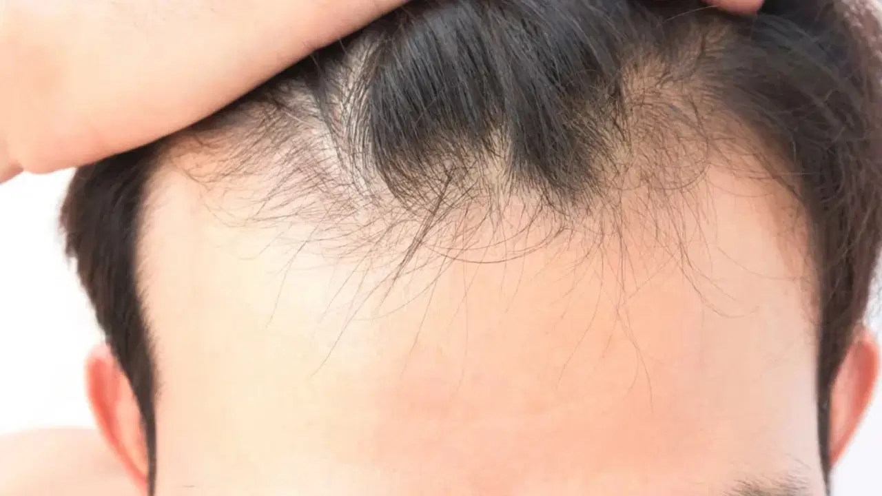 sac dokulmesinde gizli neden vitamin ve mineral eksikligi ne kadar etkili mXGU7kv4.jpg